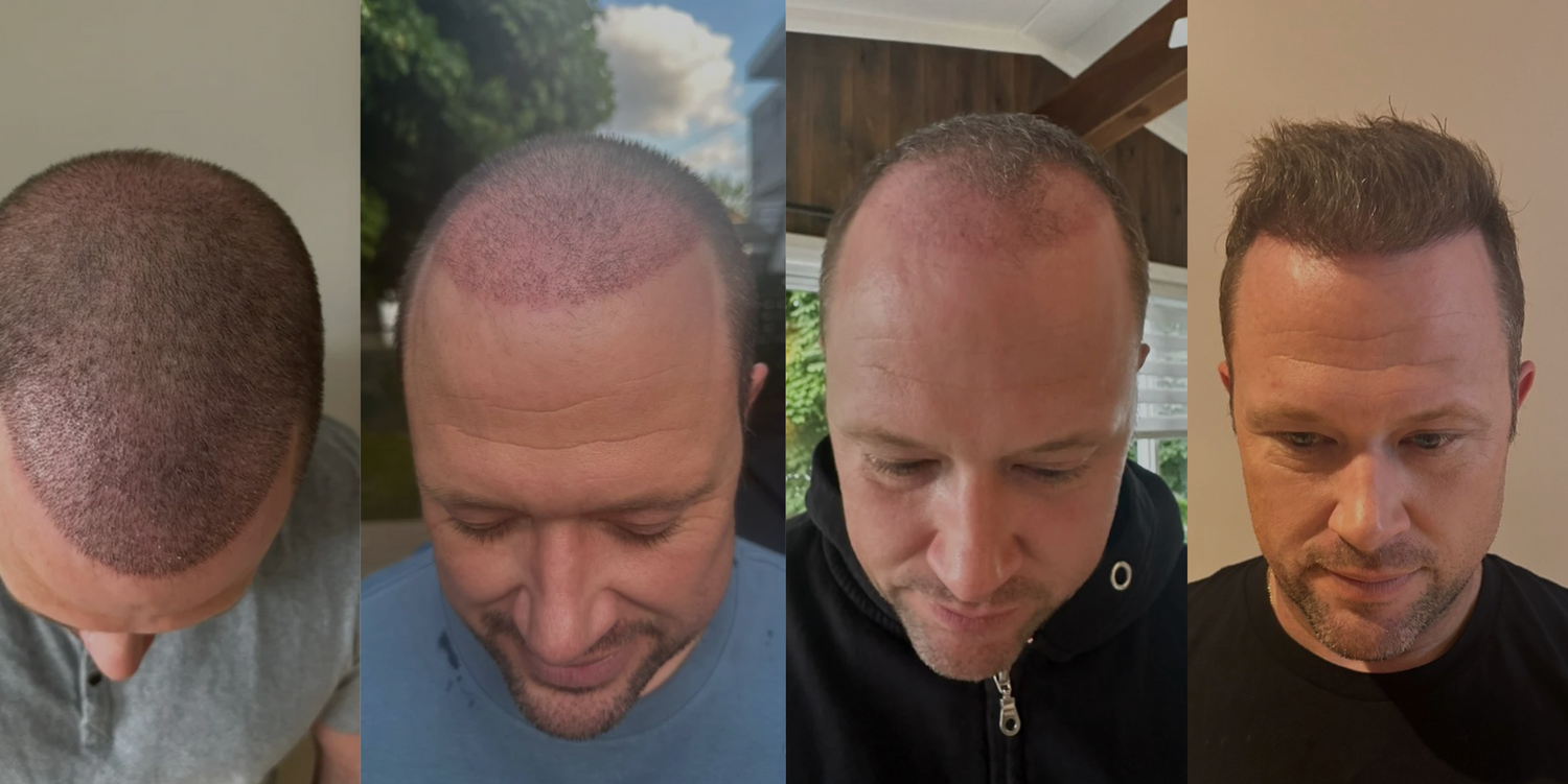 Greffe de cheveux : La vraie histoire derrière les photos avant/après